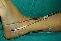 صور الرنين المغناطيسي للقدم