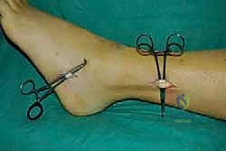 جهاز تقويم الكاحل والقدم AFO