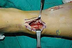 صورة طبية: نقل وتر الظنبوب الخلفي الديناميكي لعلاج تدلي القدم: استعادة الحركة والحياة الطبيعية مع الأستاذ الدكتور محمد هطيف