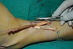 صورة طبية: نقل وتر الظنبوب الخلفي الديناميكي لعلاج تدلي القدم: استعادة الحركة والحياة الطبيعية مع الأستاذ الدكتور محمد هطيف