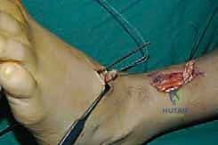 صورة طبية: نقل وتر الظنبوب الخلفي الديناميكي لعلاج تدلي القدم: استعادة الحركة والحياة الطبيعية مع الأستاذ الدكتور محمد هطيف