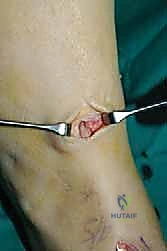 صورة طبية: نقل وتر الظنبوب الخلفي الديناميكي لعلاج تدلي القدم: استعادة الحركة والحياة الطبيعية مع الأستاذ الدكتور محمد هطيف