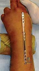 التحقق باستخدام الأشعة داخل العمليات