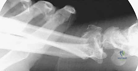 التثبيت المؤقت للصفيحة