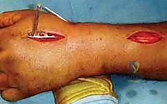 تثبيت الكسر بالصفيحة الجسرية لكسور الكعبرة البعيدة عالية الطاقة: دليل شامل للمرضى