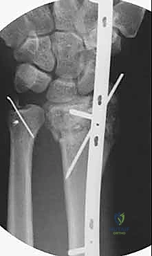 عمل الشق الجراحي بدقة متناهية