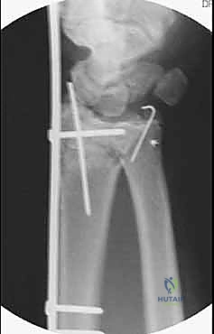 توجيه الصفيحة لتجاوز المفصل المكسور