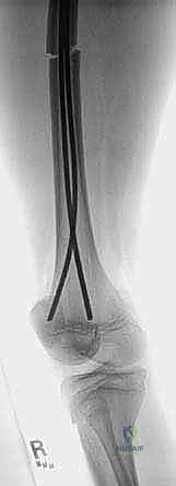 Illustration of flexible intramedullary nailing - Dr. Mohammed Hutaif