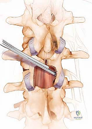 التقنيات الجراحية الحديثة في عمليات العمود الفقري
