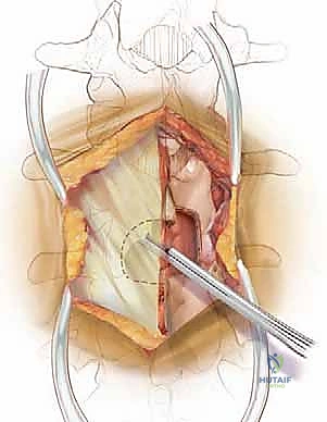 توضيح شكل القناة الشوكية والأعصاب المضغوطة