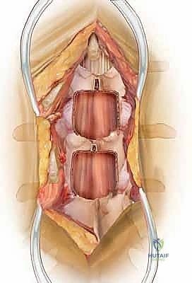 تضيق القناة الشوكية القطنية: دليل شامل للعلاج وتخفيف الضغط مع الأستاذ الدكتور محمد هطيف في صنعاء