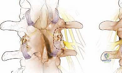 خطوات جراحة تخفيف الضغط على الأعصاب الشوكية