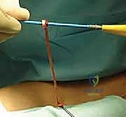 Illustration of medial clavicle excision - Dr. Mohammed Hutaif