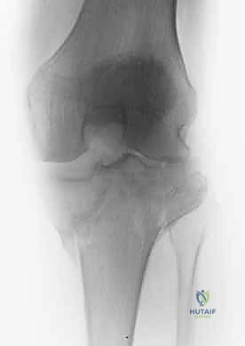 صورة توضيحية لـ كسور الهضبة الظنبوبية ثنائية اللقمة: دليل شامل للعلاج والتعافي مع الأستاذ الدكتور محمد هطيف