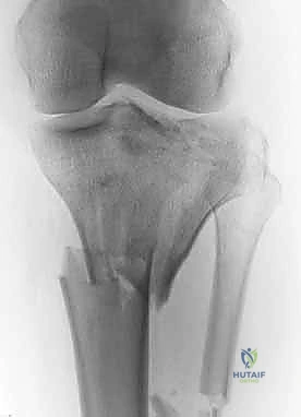 صورة توضيحية لـ كسور الهضبة الظنبوبية ثنائية اللقمة: دليل شامل للعلاج والتعافي مع الأستاذ الدكتور محمد هطيف