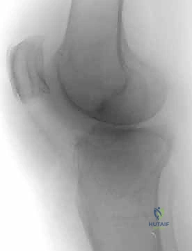 صورة طبية: كسور الهضبة الظنبوبية ثنائية اللقمة: دليل شامل للعلاج والتعافي مع الأستاذ الدكتور محمد هطيف