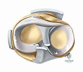 صورة توضيحية لـ كسور الهضبة الظنبوبية ثنائية اللقمة: دليل شامل للعلاج والتعافي مع الأستاذ الدكتور محمد هطيف