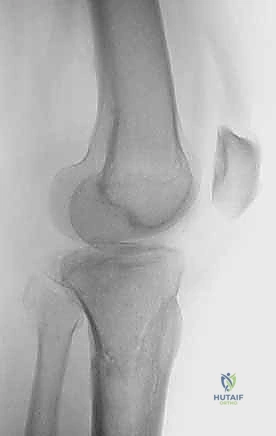 الأضرار الناتجة عن الصدمات عالية الطاقة على الركبة