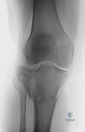 صورة توضيحية لـ كسور الهضبة الظنبوبية ثنائية اللقمة: دليل شامل للعلاج والتعافي مع الأستاذ الدكتور محمد هطيف