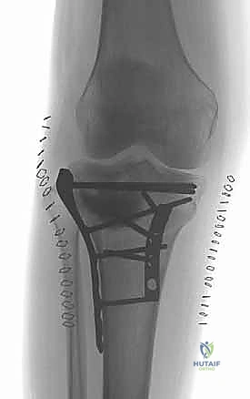 صورة توضيحية لـ كسور الهضبة الظنبوبية ثنائية اللقمة: دليل شامل للعلاج والتعافي مع الأستاذ الدكتور محمد هطيف