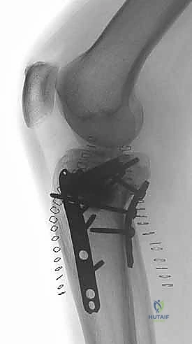 كسور الهضبة الظنبوبية ثنائية اللقمة: دليل شامل للعلاج والتعافي مع الأستاذ الدكتور محمد هطيف