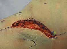 صورة توضيحية لـ كسور الهضبة الظنبوبية ثنائية اللقمة: دليل شامل للعلاج والتعافي مع الأستاذ الدكتور محمد هطيف