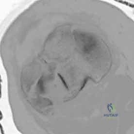 صورة طبية: كسور الهضبة الظنبوبية ثنائية اللقمة: دليل شامل للعلاج والتعافي مع الأستاذ الدكتور محمد هطيف