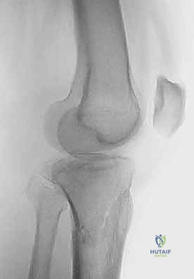 توضيح إشعاعي لأنماط الكسور المختلفة حسب تصنيف شاتزكر