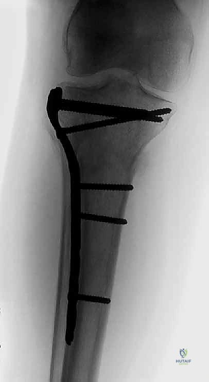 تورم المفصل وتراكم السوائل الدموية بعد الإصابة