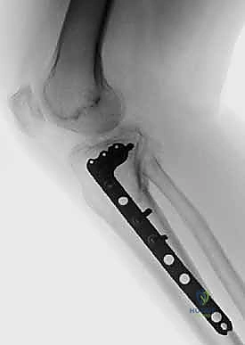 صورة أشعة مقطعية توضح التخطيط الجراحي الدقيق للكسر