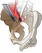 Periacetabular Osteotomy: A Masterclass in Acetabular Reorientation for Hip Preservation