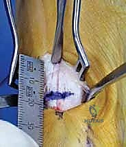 تفاصيل تشريحية دقيقة للقدم الأمامية قبل إجراء عملية قطع العظم الوتدي المفتوح