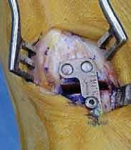 خطوات جراحية دقيقة في عملية تصحيح انحراف إبهام القدم الأروح