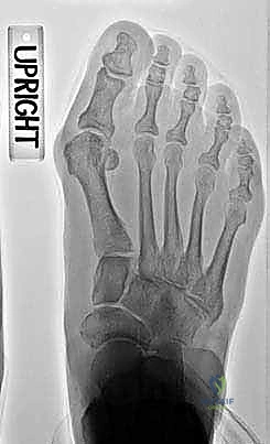 عملية قطع العظم الوتدي المفتوح في مشط القدم القريب: حل جذري لتصحيح إبهام القدم الأروح مع الأستاذ الدكتور محمد هطيف