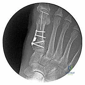 النتيجة النهائية وتثبيت العظم بعد عملية قطع العظم الوتدي المفتوح في مشط القدم