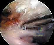 ABOS & OITE Orthopaedic Exam Questions: Biceps, Osteosarcoma, Tarsal Coalitions | Part 21551