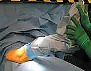 Illustration of femoral osteotomy femoral - Dr. Mohammed Hutaif