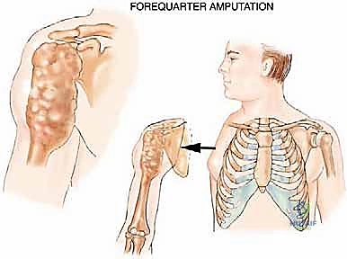 التخطيط الجراحي لاستئصال الربع الأمامي