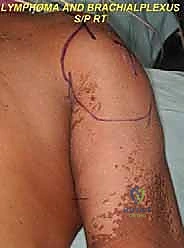 صورة طبية: استئصال الربع الأمامي: دليل شامل للمرضى مع الأستاذ الدكتور محمد هطيف