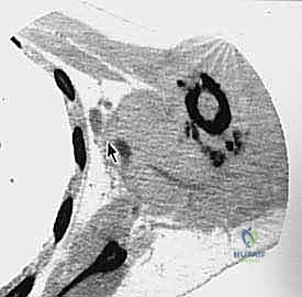 ربط الأوعية الدموية الرئيسية