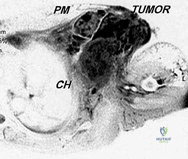 الوصول إلى عظم الترقوة