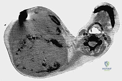 صورة شعاعية مقطعية توضح انتشار الورم