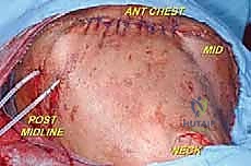 صورة توضيحية لـ استئصال الربع الأمامي: دليل شامل للمرضى مع الأستاذ الدكتور محمد هطيف