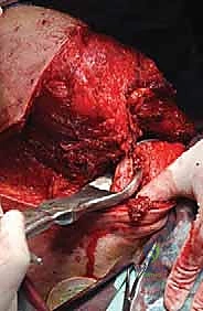 صورة طبية: استئصال الربع الأمامي: دليل شامل للمرضى مع الأستاذ الدكتور محمد هطيف