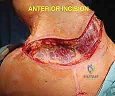 استئصال الربع الأمامي: دليل شامل للمرضى مع الأستاذ الدكتور محمد هطيف