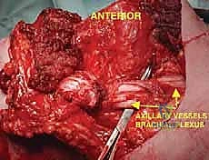 صورة طبية: استئصال الربع الأمامي: دليل شامل للمرضى مع الأستاذ الدكتور محمد هطيف