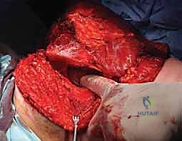 الشق الجراحي الأولي