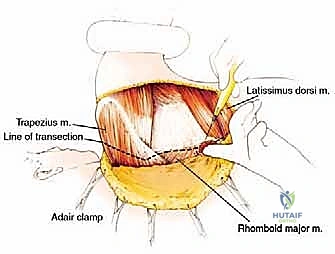تحديد الشقوق الجراحية على جلد المريض