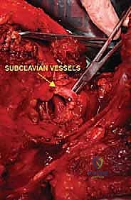 صورة طبية: استئصال الربع الأمامي: دليل شامل للمرضى مع الأستاذ الدكتور محمد هطيف