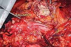 صورة توضيحية لـ استئصال الربع الأمامي: دليل شامل للمرضى مع الأستاذ الدكتور محمد هطيف